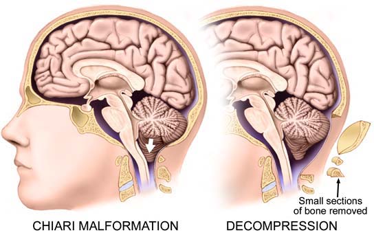 chiari-malformation-lg